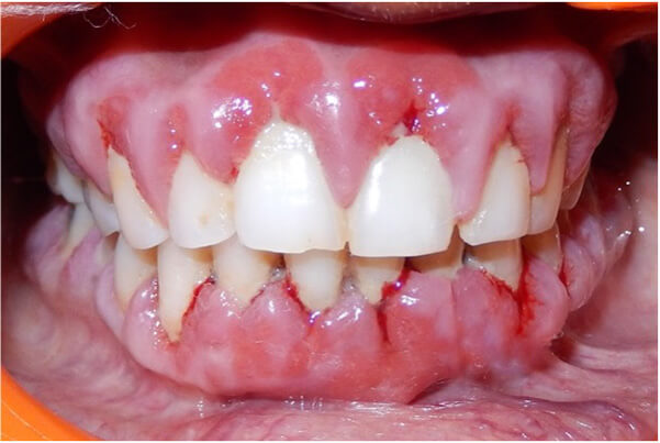 Before gingival enlargement